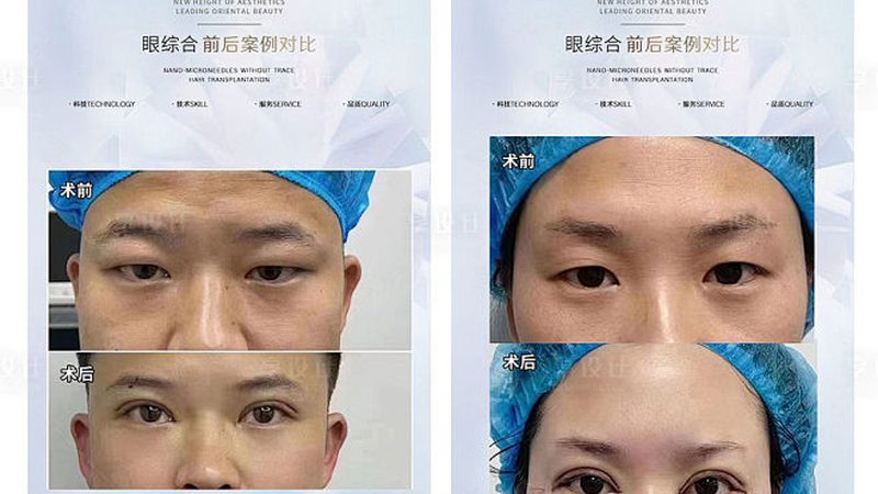 术后护理，美丽之路上的关键一步