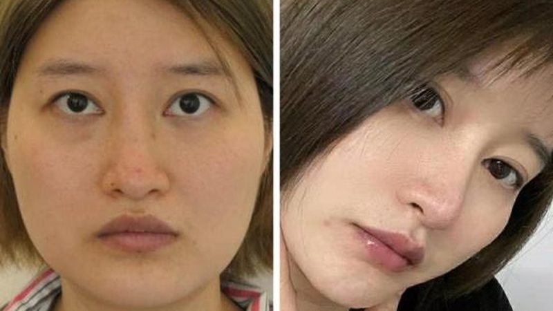 肉毒素除抬头纹，价格与哪些因素相关？**