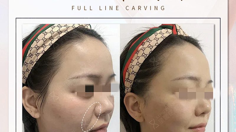 隆鼻修复，揭秘价格背后的秘密