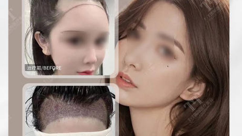 激光美容祛雀斑：揭秘价格背后的秘密