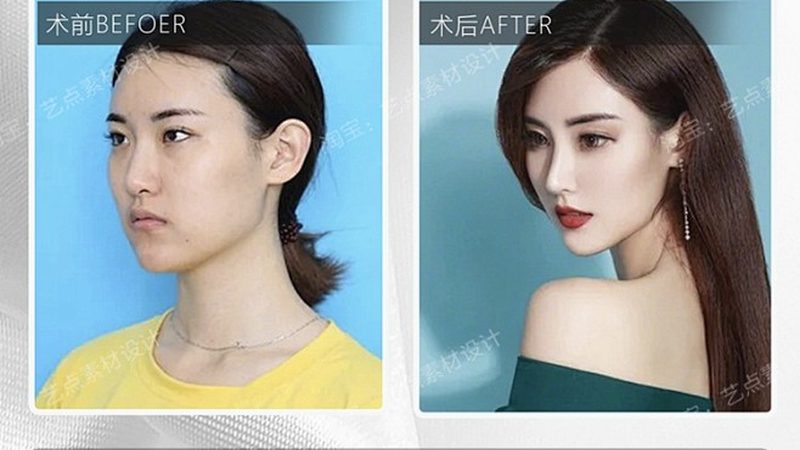 揭秘医美注射材料：适用人群与选择要点