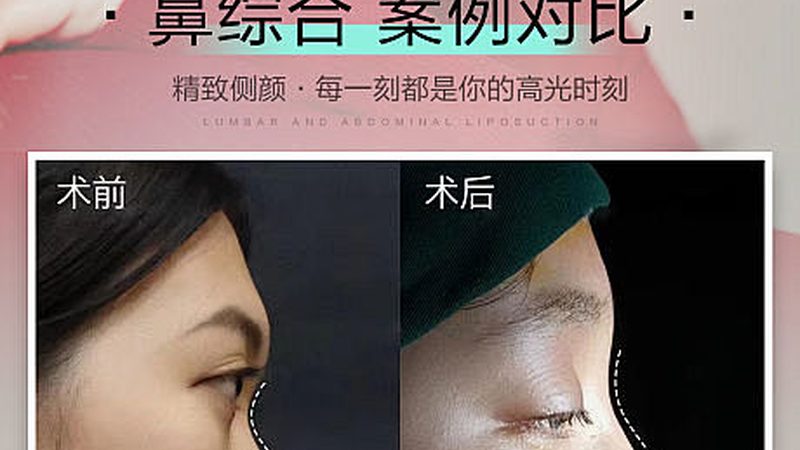 广州隆鼻手术，价格与价值如何权衡？**