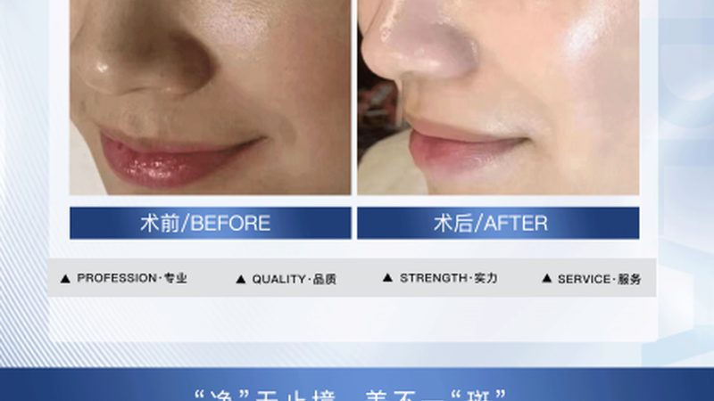 轻医美VS传统医美：揭秘恢复期短的秘密