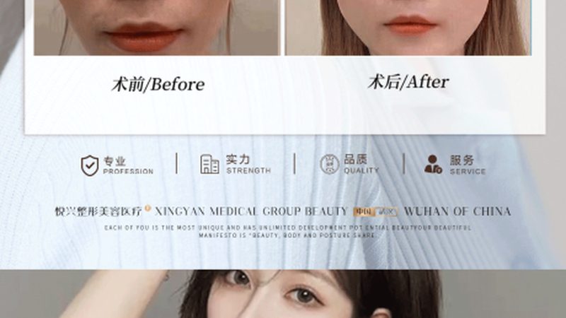 双眼皮手术价格：2025年你该了解的真相