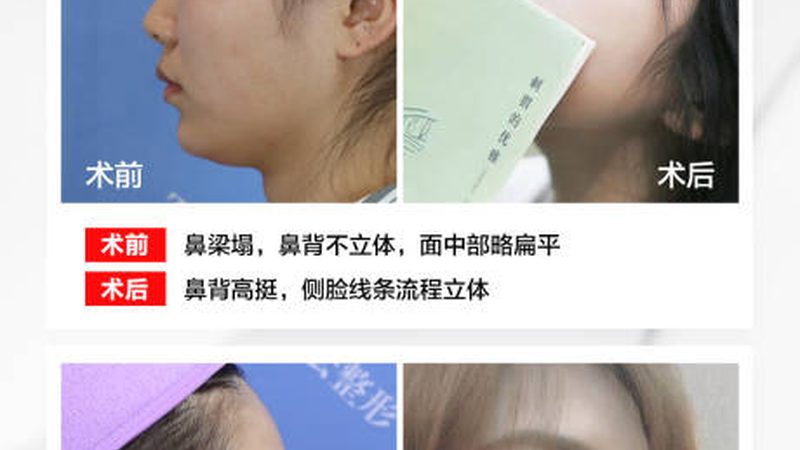 **误区：家用瘦脸仪器可以替代专业美容手术**