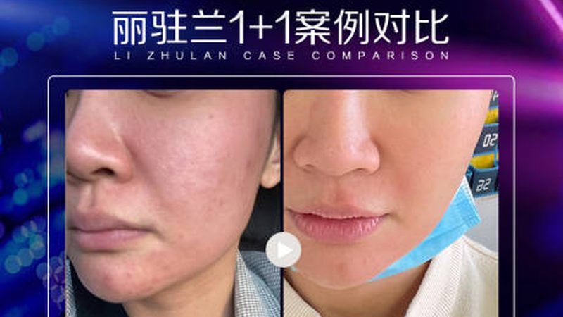 揭秘光子嫩肤仪：十大品牌排名及价格背后的秘密
