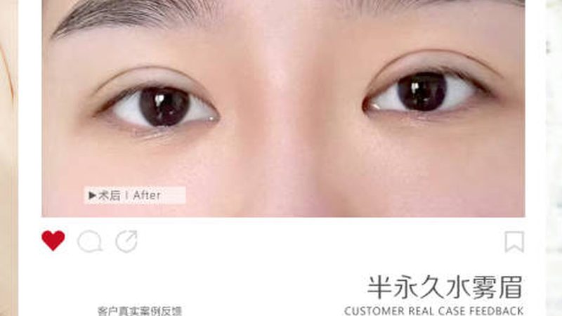 割双眼皮后化妆上学，恢复期需知