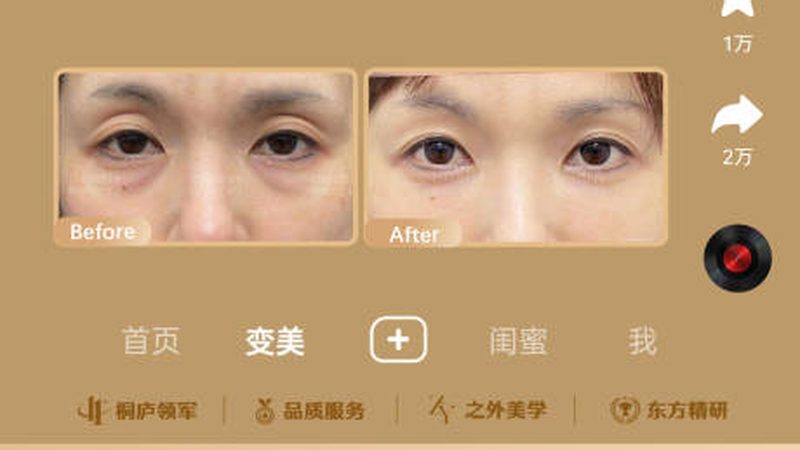 玻尿酸注射，成都代理价格表背后的秘密